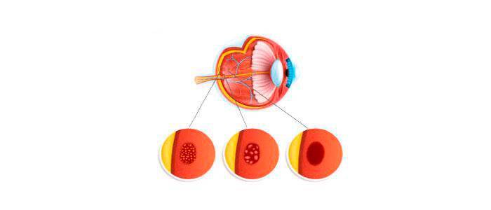 Uses of beta carotenes for macular degeneration
