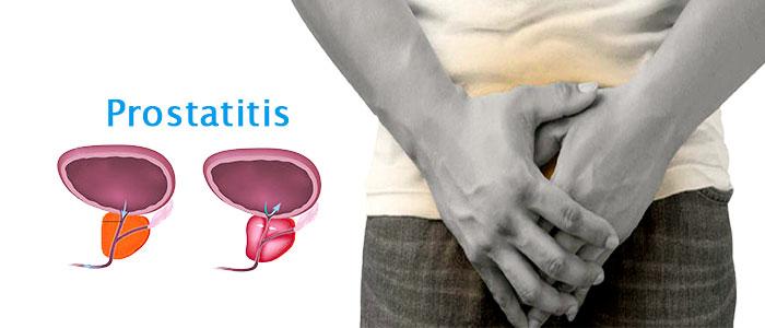 Cómo evitar la prostatitis y los problemas de próstata con quercetina